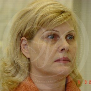 Тотальный лифтинг лица: эндоскопия лба, средней зоны лица, блефаропластика нижних век, СМАС-лифтинг лица, Три четверти, фото До