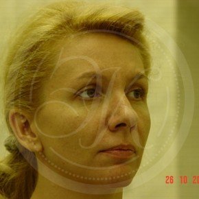 Эндоскопический лифтинг лба и средней зоны лица, Три четверти, фото До