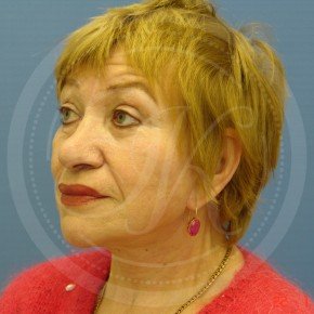 СМАС-лифтинг лица, Платизмопластика, Три четверти, фото После
