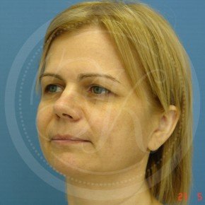 Тотальный лифтинг лица, Три четверти, фото До