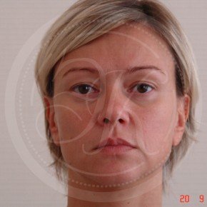 Эндоскопический лифтинг лба, эндоскопический лифтинг средней зоны лица, блефаропластика нижних век, Спереди, фото До