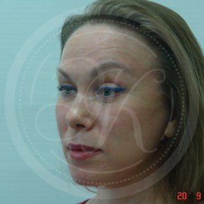 Тотальный эндоскопичесекий лифтинг лица, Три четверти, фото После