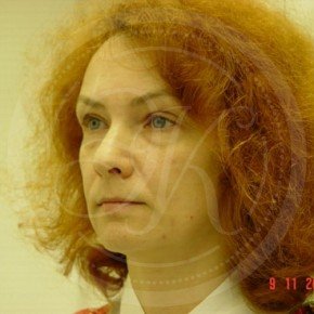 Эндоскопический лифтинг лба, блефаропластика нижних век, СМАС-лифтинг лица, Три четверти, фото До