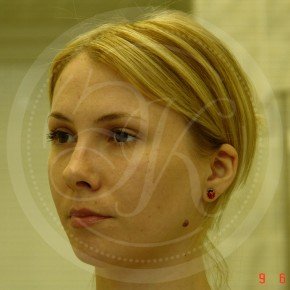 Эндоскопический лифтинг лба, Три четверти, фото После