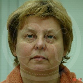Эндоскопический лифтинг лба, блефаропластика нижних век, Спереди, фото До