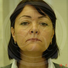 Тотальный лифтинг лица: эндоскопия лба, средней зоны лица, блефаропластика нижних век, СМАС-лифтинг лица, платизмопластика, Спереди, фото До