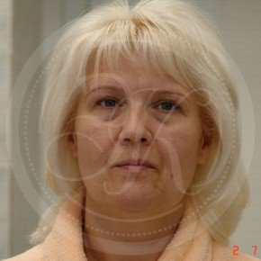 Тотальный лифтинг лица: эндоскопия лба, средней зоны лица, блефаропластика нижних век, СМАС-лифтинг лица, платизмопластика, Спереди, фото До