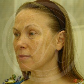 Тотальный эндоскопичесекий лифтинг лица, Три четверти, фото До