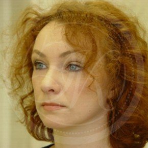 Эндоскопический лифтинг лба, блефаропластика нижних век, СМАС-лифтинг лица, Три четверти, фото После