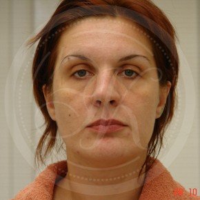 Эндоскопический лифтинг лба, средней зоны лица, блефаропластика нижних век, Спереди, фото До