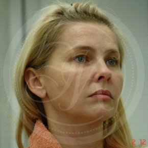 Тотальный лифтинг лица: эндоскопия лба, средней зоны лица, блефаропластика нижних век, СМАС-лифтинг лица, Три четверти, фото До