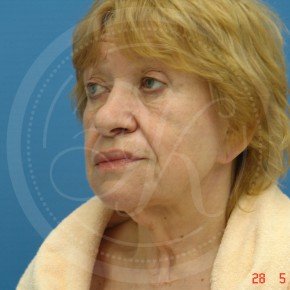 СМАС-лифтинг лица, Платизмопластика, Три четверти, фото До