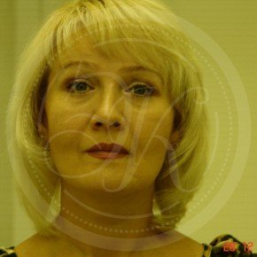 Тотальный лифтинг лица: эндоскопия лба, средней зоны лица, блефаропластика нижних век, СМАС-лифтинг лица, платизмопластика, Спереди, фото После